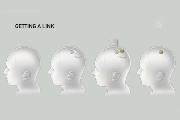 Mesurant 23mm de largeur et 8mm d’épaisseur, la puce développée par Neuralink pourra selon Elon Musk être implantée dans nos cerveaux pour nous guérir ou nous “augmenter” // Source : Neuralink